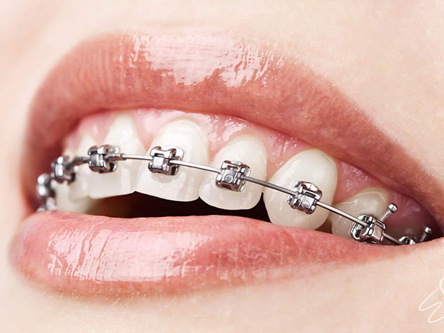 Ortodonti (Estetik ve Klasik Sistemler)