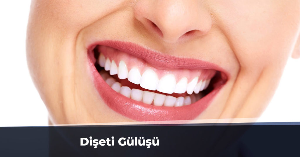 Dişeti Gülüşü Sebepleri