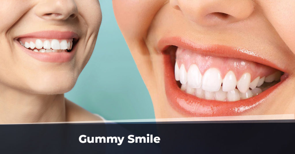 Gummy Smile - Diş Eti Gülümsemesi - Gummy Smile Nedir?