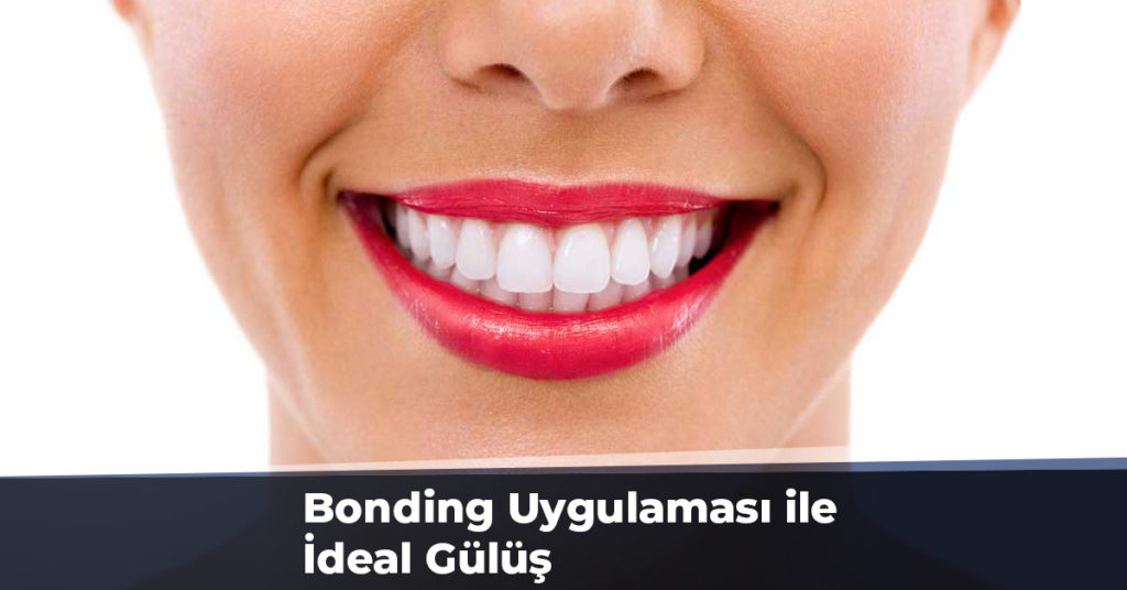 Bonding Uygulaması ile İdeal Gülüş