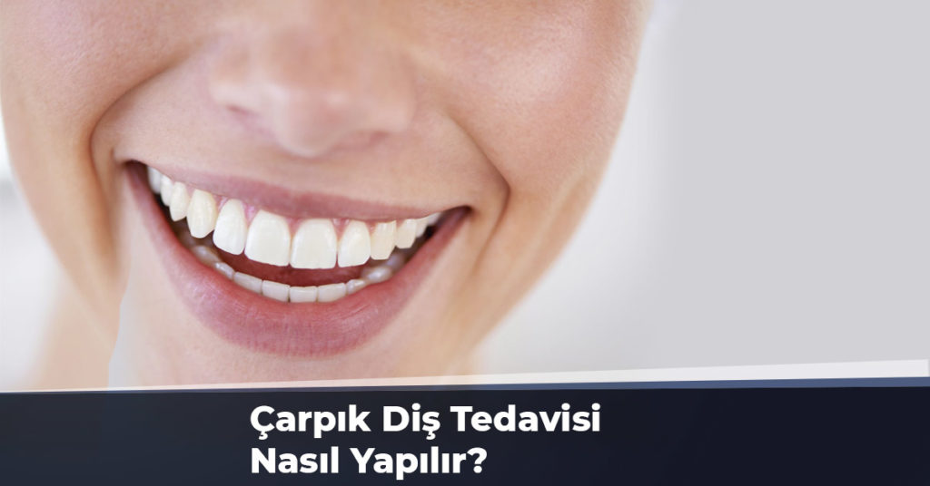 Çarpık Diş Tedavisi Nasıl Yapılır?