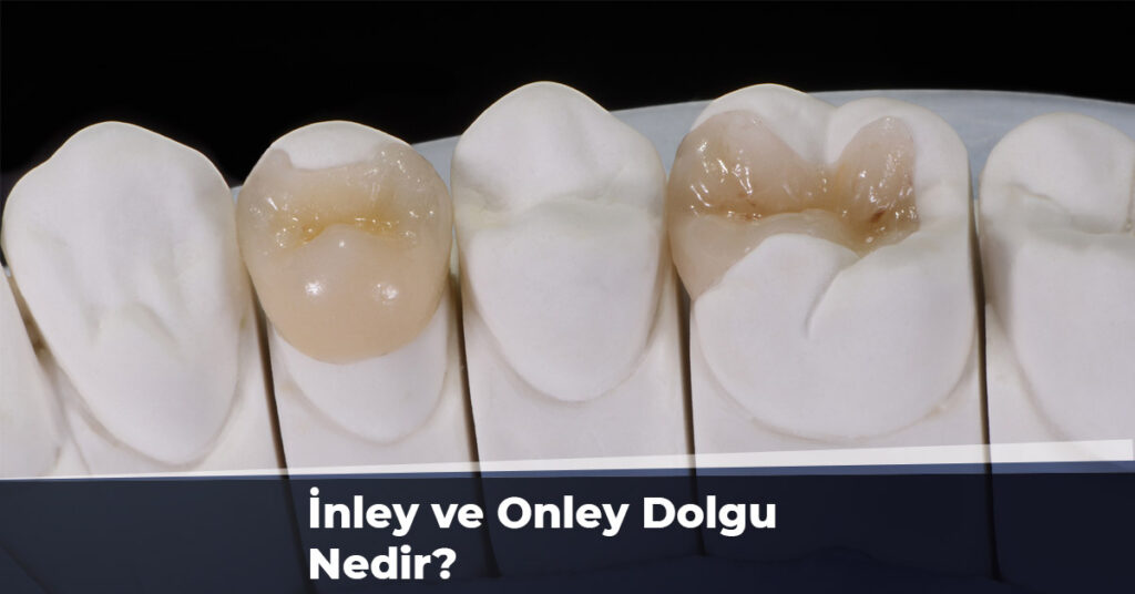 İnley ve Onley Dolgu Nedir?