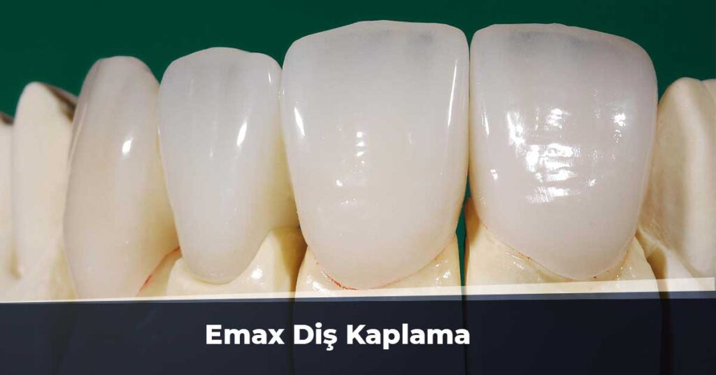 Emax Diş Kaplama