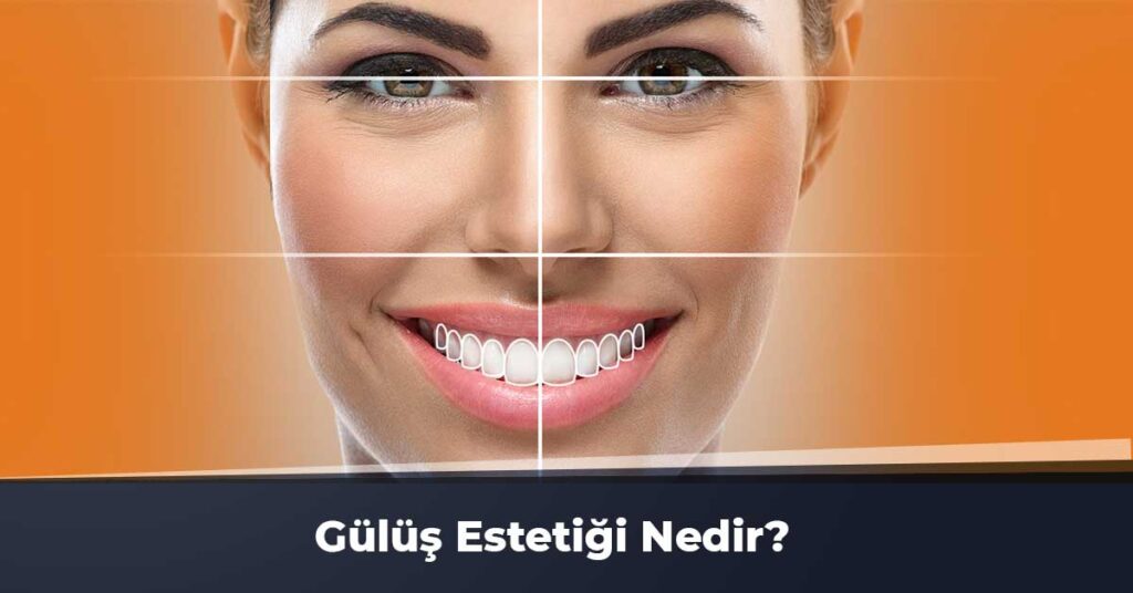 Gülüş Estetiği Nedir?