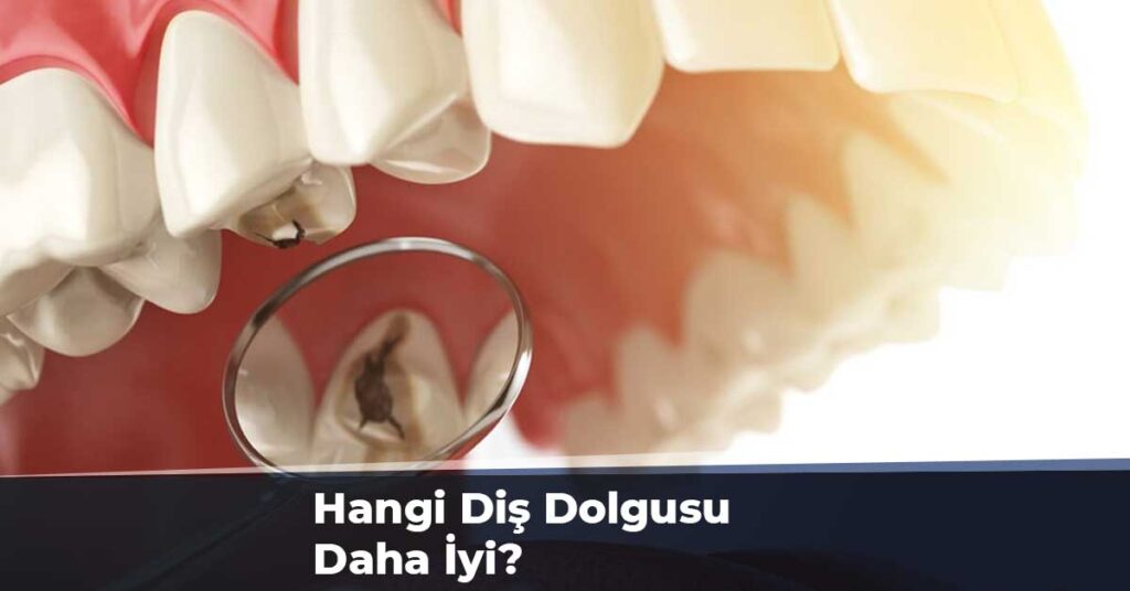 Hangi Diş Dolgusu Daha İyi?