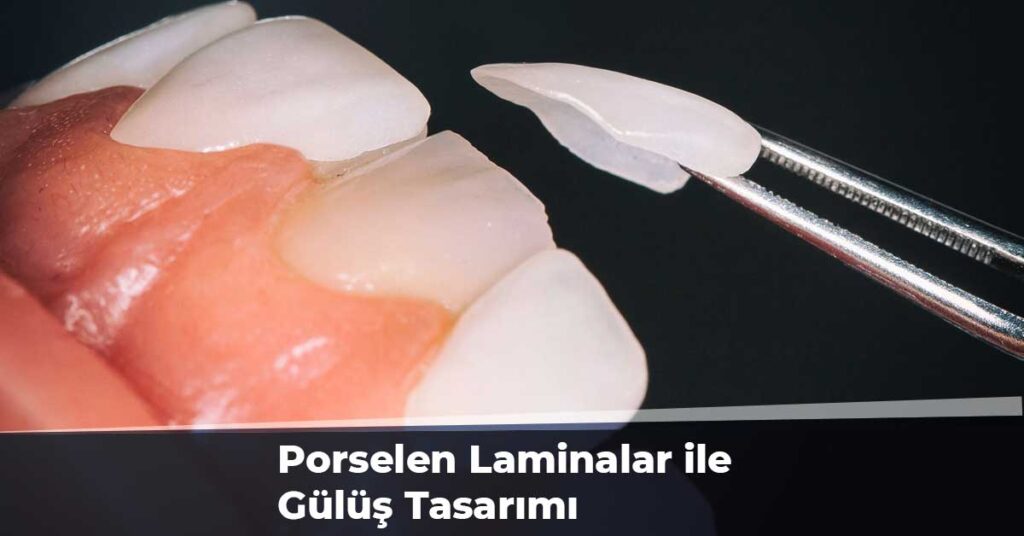 Porselen Laminalar