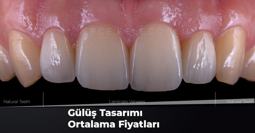 Gülüş Tasarımı Ortalama Fiyatları