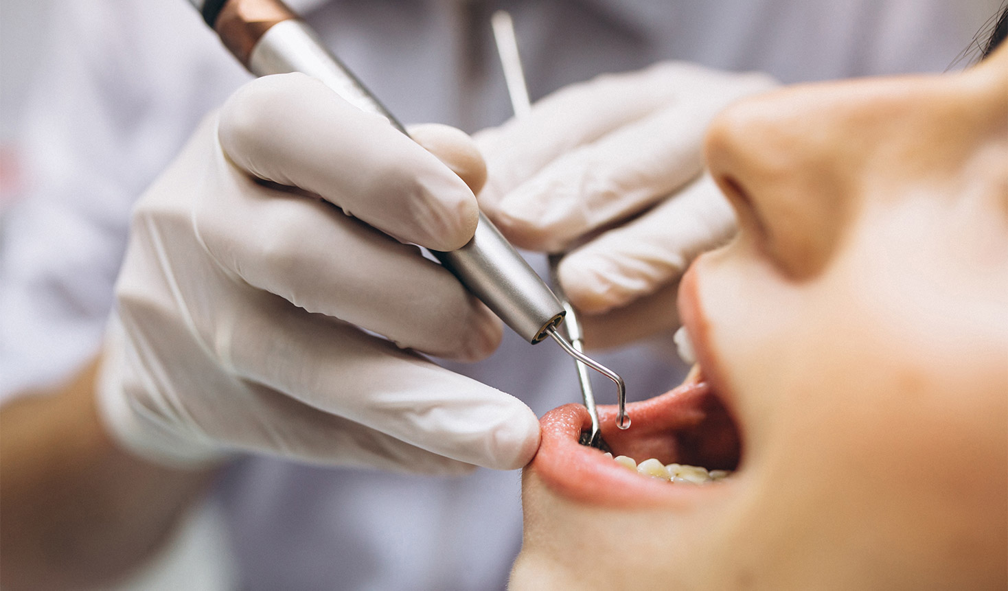 Diş Eti İltihabı Tedavisi Nasıl Yapılır?