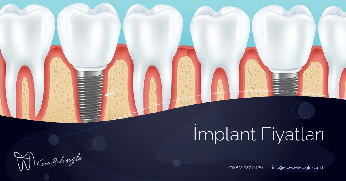 İmplant Fiyatları Ankara