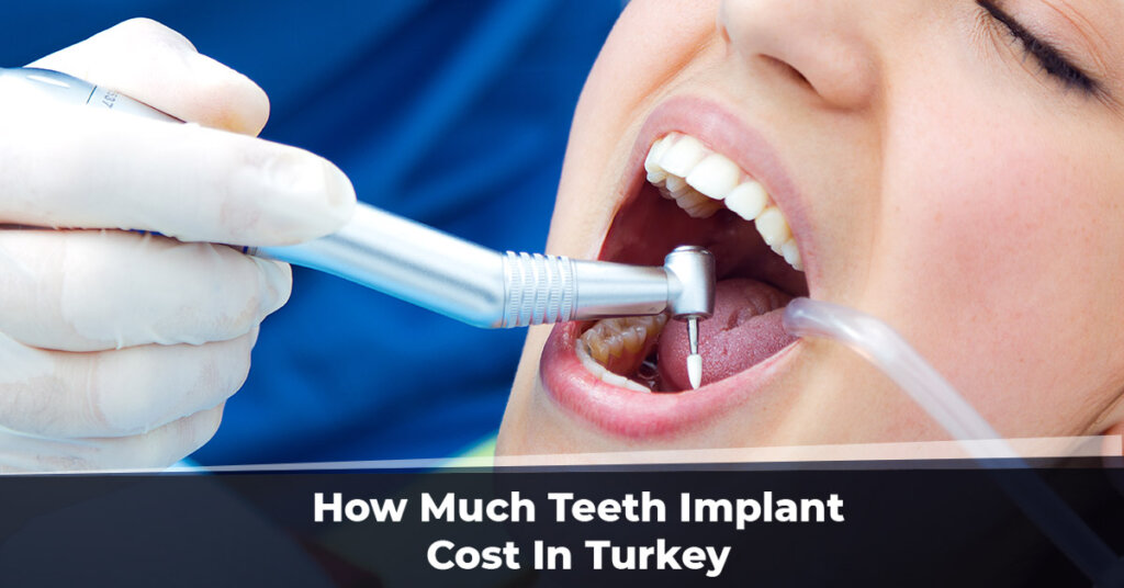 cost-of-full-mouth-dental-implants-uk-2019