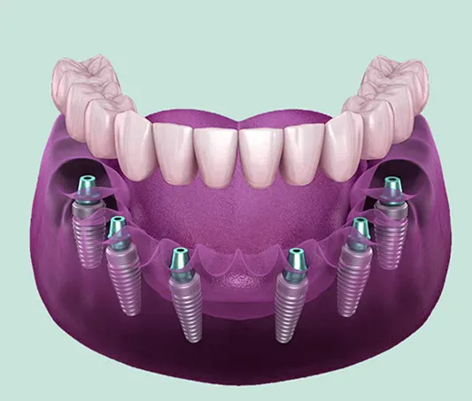 All On- Six Dental Implant