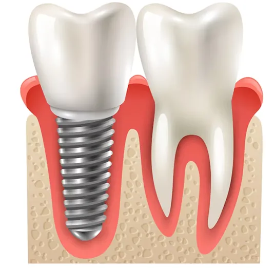 Dental Veneers vs. Implants