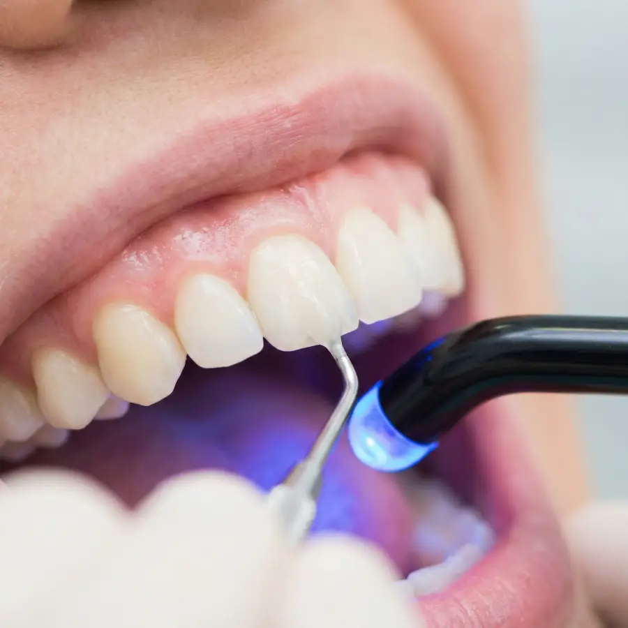 Estetik Diş Dolgusu 001