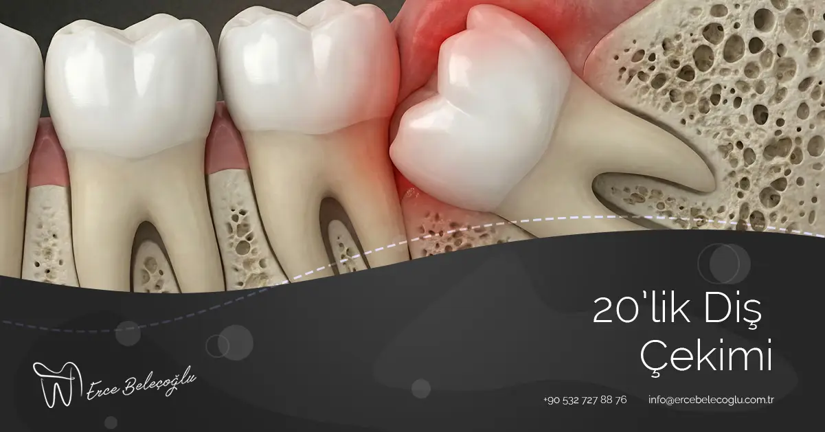Yirmilik Diş Nedir? Nasıl Çıkar