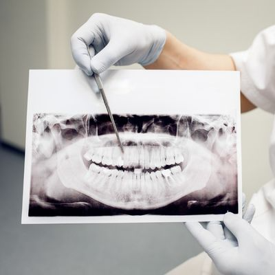 Çene Kemiği Erimesi