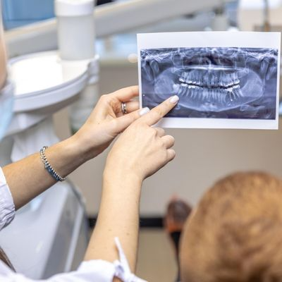 Çocuklarda Kanal Tedavisi