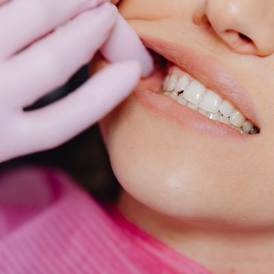 Çürük Diş Tedavisi