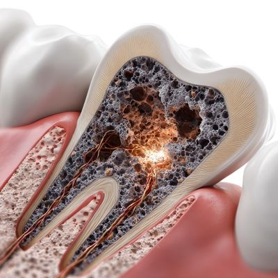 Çürük Diş Tedavisi