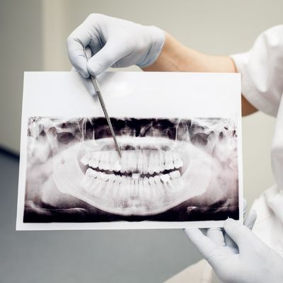 Kırık Diş Tedavisi